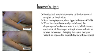 hoover’s sign
41
Paradoxical inward movement of the lower costal
margins on inspiration
Seen in emphysema, chest hyperinflation – COPD
When the chest becomes hyperinflated, the
diaphragm often becomes stretched, which causes
contration of diaphragm at inspiration results in an
inward movement , bringing the costal margins
with it, as opposed to normal downward movement
 