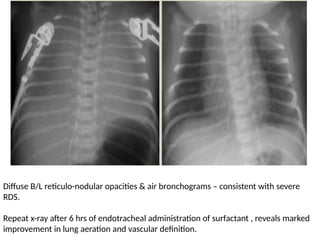 Neonatal Rds Radiology Respiratory distress in Newborn radiology aspect | PPTX