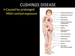 CUSHINGS DISEASE Caused by prolonged HIGH cortisol exposure 