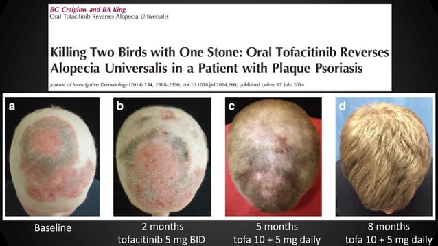 Response to Tofacitinib Therapy of Eyebrows and Eyelashes in Alopecia ...