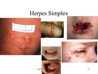 Herpes Simplex

Prof DR Dr Ariyanto Harsono
SpA(K)

27

 
