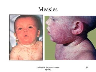 Measles

Prof DR Dr Ariyanto Harsono
SpA(K)

35

 