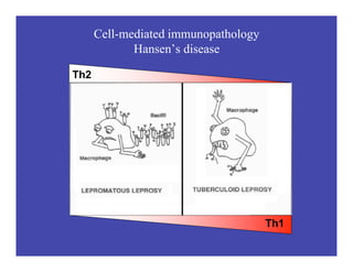Cell-mediated immunopathology
Hansen’s disease
Th2
Th1
 