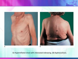 A) Hyperinflated chest with intercostal indrawing. (B) Kyphoscoliosis.
 