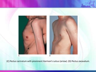(C) Pectus carinatum with prominent Harrison’s sulcus (arrow). (D) Pectus excavatum.
 