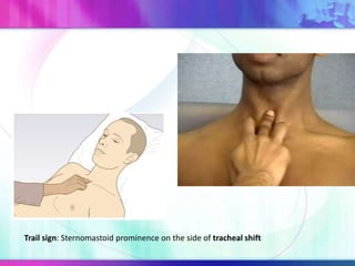 Trail sign: Sternomastoid prominence on the side of tracheal shift
 
