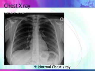 Normal Chest x ray
 