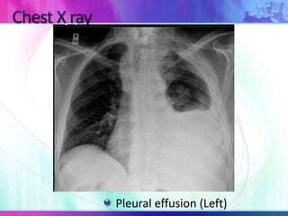 Pleural effusion (Left)
 