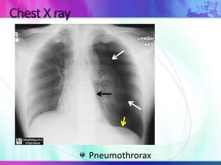 Pneumothrorax
 