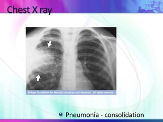 Pneumonia - consolidation
 