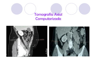Tomografía Axial Computarizada 