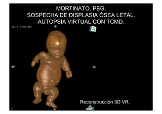 MORTINATO. PEG.
SOSPECHA DE DISPLASIA ÓSEA LETAL.
   AUTOPSIA VIRTUAL CON TCMD.




                Reconstrucción 3D VR.
 
