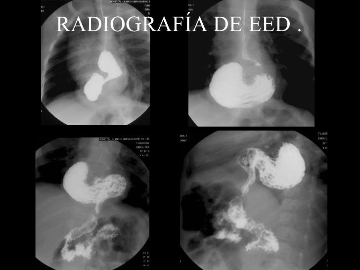 Seriografia De Esôfago Estômago E Duodeno Codigo