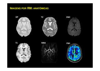 DP T2 DWI
IMAGENS POR RM: ANATÔMICAS
T1 MRA PWI
 