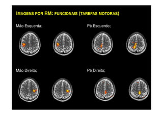 Mão Esquerda; Pé Esquerdo;
IMAGENS POR RM: FUNCIONAIS (TAREFAS MOTORAS)
Mão Direita; Pé Direito;
 