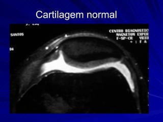 Cartilagem normal 