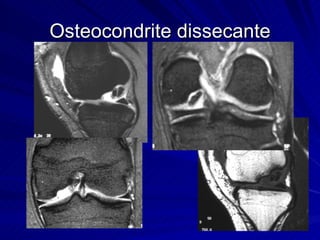 Osteocondrite dissecante 