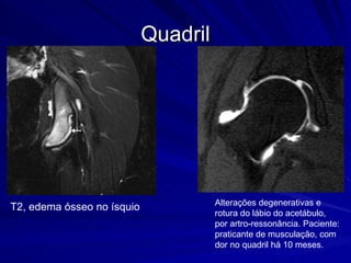 Quadril T2, edema ósseo no ísquio  Alterações degenerativas e rotura do lábio do acetábulo, por artro-ressonância. Paciente: praticante de musculação, com dor no quadril há 10 meses.  
