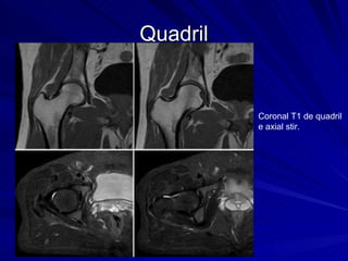 Quadril Coronal T1 de quadril e axial stir. 