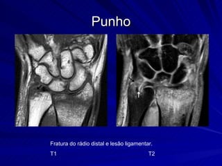 Punho Fratura do rádio distal e lesão ligamentar. T1   T2 
