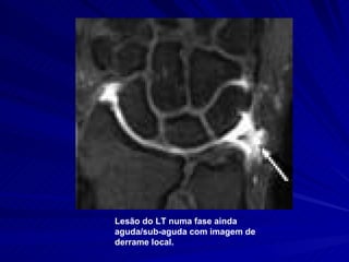 Lesão do LT numa fase ainda aguda/sub-aguda com imagem de derrame local.   