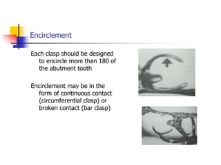 Encirclement
Each clasp should be designed
to encircle more than 180 of
the abutment tooth
Encirclement may be in the
form of continuous contact
(circumferential clasp) or
broken contact (bar clasp)
 