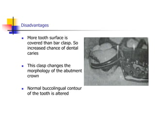 Disadvantages
 More tooth surface is
covered than bar clasp. So
increased chance of dental
caries
 This clasp changes the
morphology of the abutment
crown
 Normal buccolingual contour
of the tooth is altered
 
