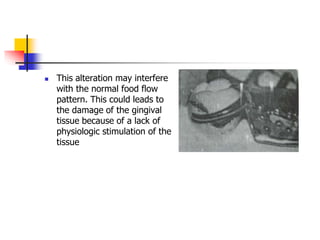  This alteration may interfere
with the normal food flow
pattern. This could leads to
the damage of the gingival
tissue because of a lack of
physiologic stimulation of the
tissue
 