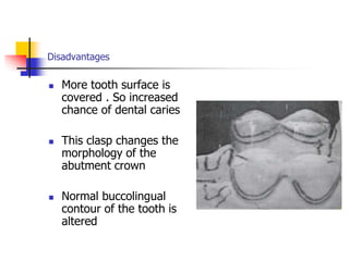 Disadvantages
 More tooth surface is
covered . So increased
chance of dental caries
 This clasp changes the
morphology of the
abutment crown
 Normal buccolingual
contour of the tooth is
altered
 