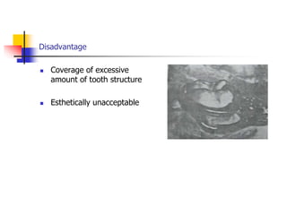 Disadvantage
 Coverage of excessive
amount of tooth structure
 Esthetically unacceptable
 