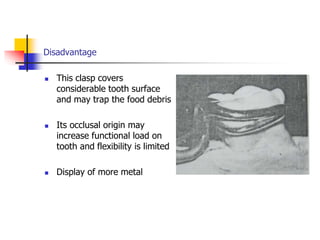 Disadvantage
 This clasp covers
considerable tooth surface
and may trap the food debris
 Its occlusal origin may
increase functional load on
tooth and flexibility is limited
 Display of more metal
 