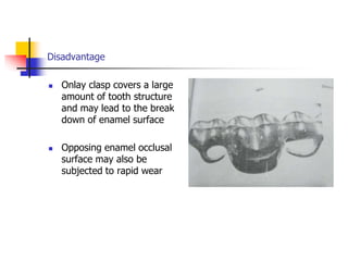 Disadvantage
 Onlay clasp covers a large
amount of tooth structure
and may lead to the break
down of enamel surface
 Opposing enamel occlusal
surface may also be
subjected to rapid wear
 