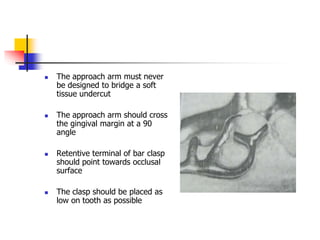  The approach arm must never
be designed to bridge a soft
tissue undercut
 The approach arm should cross
the gingival margin at a 90
angle
 Retentive terminal of bar clasp
should point towards occlusal
surface
 The clasp should be placed as
low on tooth as possible
 