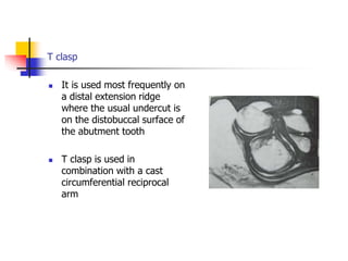 T clasp
 It is used most frequently on
a distal extension ridge
where the usual undercut is
on the distobuccal surface of
the abutment tooth
 T clasp is used in
combination with a cast
circumferential reciprocal
arm
 