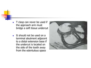  T clasp can never be used if
the approach arm must
bridge a soft tissue undercut
 It should not be used on a
terminal abutment adjacent
to a distal extension base if
the undercut is located on
the side of the tooth away
from the edentulous space
 