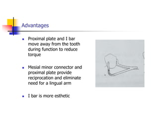 Advantages
 Proximal plate and I bar
move away from the tooth
during function to reduce
torque
 Mesial minor connector and
proximal plate provide
reciprocation and eliminate
need for a lingual arm
 I bar is more esthetic
 