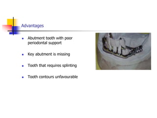 Advantages
 Abutment tooth with poor
periodontal support
 Key abutment is missing
 Tooth that requires splinting
 Tooth contours unfavourable
 