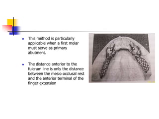  This method is particularly
applicable when a first molar
must serve as primary
abutment.
 The distance anterior to the
fulcrum line is only the distance
between the mesio occlusal rest
and the anterior terminal of the
finger extension
 