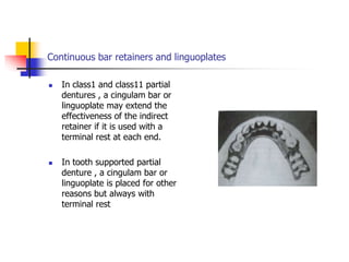 Continuous bar retainers and linguoplates
 In class1 and class11 partial
dentures , a cingulam bar or
linguoplate may extend the
effectiveness of the indirect
retainer if it is used with a
terminal rest at each end.
 In tooth supported partial
denture , a cingulam bar or
linguoplate is placed for other
reasons but always with
terminal rest
 