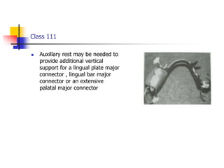 Class 111
 Auxillary rest may be needed to
provide additional vertical
support for a lingual plate major
connector , lingual bar major
connector or an extensive
palatal major connector
 