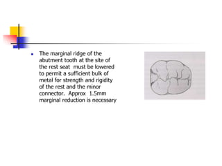  The marginal ridge of the
abutment tooth at the site of
the rest seat must be lowered
to permit a sufficient bulk of
metal for strength and rigidity
of the rest and the minor
connector. Approx 1.5mm
marginal reduction is necessary
 
