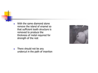  With the same diamond stone
remove the island of enamel so
that sufficient tooth structure is
removed to produce the
thickness of metal required for
strength of the rest
 There should not be any
undercut in the path of insertion
 