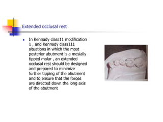 Extended occlusal rest
 In Kennady class11 modification
1 , and Kennady class111
situations in which the most
posterior abutment is a mesially
tipped molar , an extended
occlusal rest should be designed
and prepared to minimize
further tipping of the abutment
and to ensure that the forces
are directed down the long axis
of the abutment
 