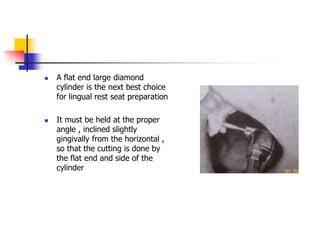  A flat end large diamond
cylinder is the next best choice
for lingual rest seat preparation
 It must be held at the proper
angle , inclined slightly
gingivally from the horizontal ,
so that the cutting is done by
the flat end and side of the
cylinder
 