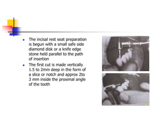  The incisal rest seat preparation
is begun with a small safe side
diamond disk or a knife edge
stone held parallel to the path
of insertion
 The first cut is made vertically
1.5 to 2mm deep in the form of
a slice or notch and approx 2to
3 mm inside the proximal angle
of the tooth
 