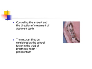  Controlling the amount and
the direction of movement of
abutment teeth
 The rest can thus be
considered as the control
factor in the triad of
prosthesis- tooth -
periodontium
 