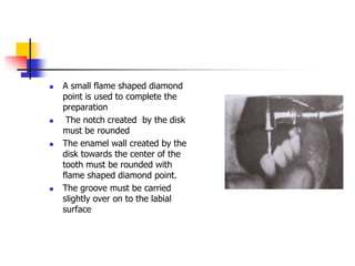  A small flame shaped diamond
point is used to complete the
preparation
 The notch created by the disk
must be rounded
 The enamel wall created by the
disk towards the center of the
tooth must be rounded with
flame shaped diamond point.
 The groove must be carried
slightly over on to the labial
surface
 