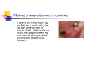 Milled rest or semiprecision rest or internal rest
 It consists of a narrow slot or key
way built into a metal casting that
has been constructed for an
abutment tooth , and into which is
fitted a male attachment that has
been made as an integral part of
the removable partial denture
framework
 