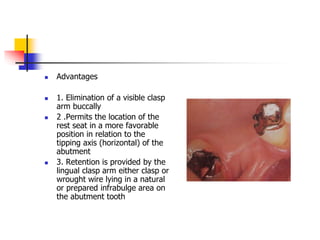  Advantages
 1. Elimination of a visible clasp
arm buccally
 2 .Permits the location of the
rest seat in a more favorable
position in relation to the
tipping axis (horizontal) of the
abutment
 3. Retention is provided by the
lingual clasp arm either clasp or
wrought wire lying in a natural
or prepared infrabulge area on
the abutment tooth
 