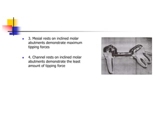  3. Mesial rests on inclined molar
abutments demonstrate maximum
tipping forces
 4. Channel rests on inclined molar
abutments demonstrate the least
amount of tipping force
 